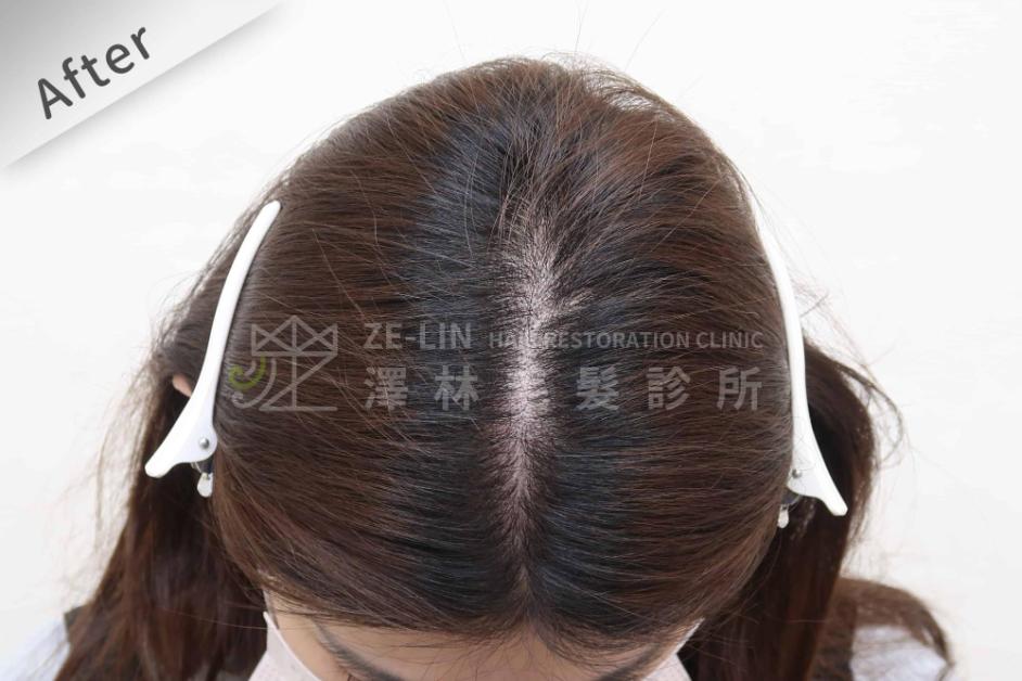 女性頭頂植髮案例1-術後