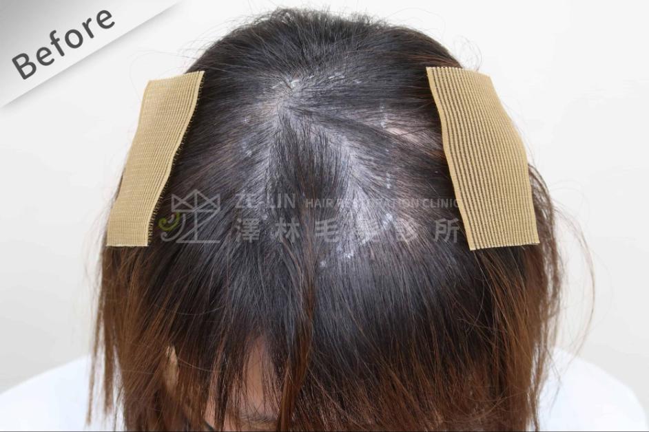 女性頭頂植髮案例2-術前