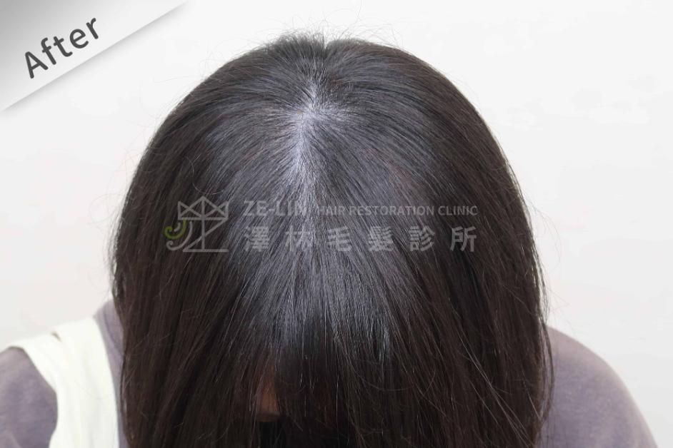 女性頭頂植髮案例2-術後