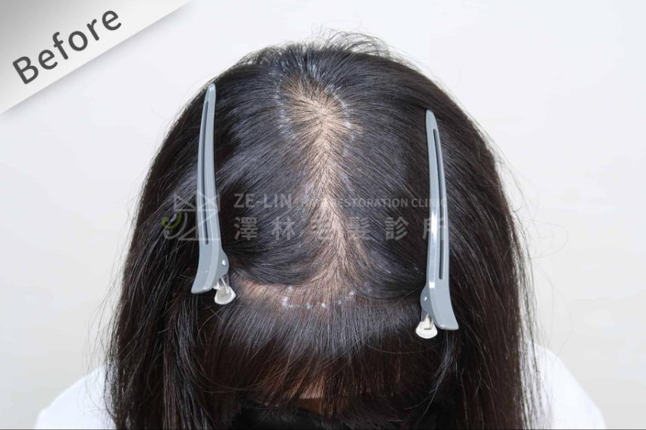 女性頭頂植髮案例3-術前