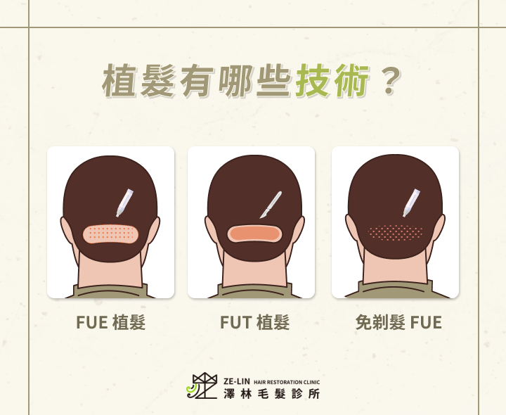 植髮有哪些技術?